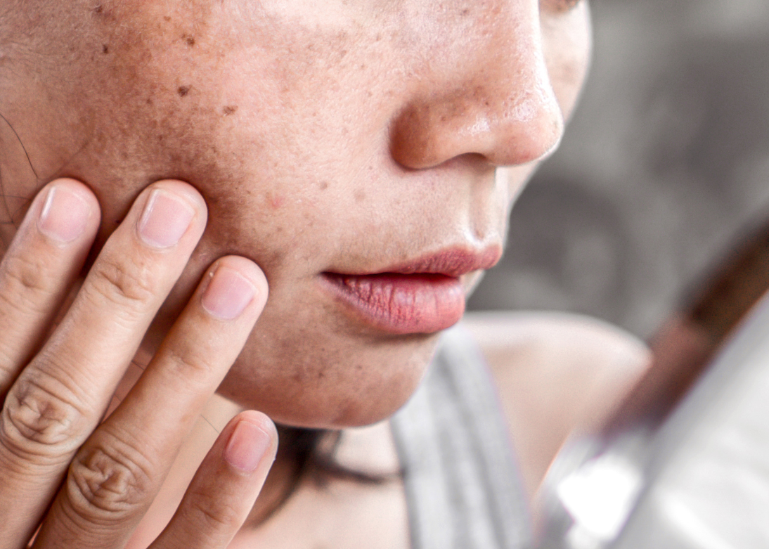 Pigmentation / Melasma